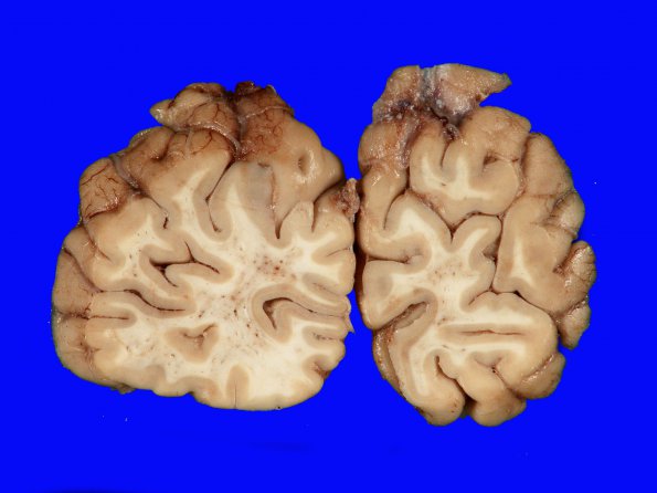 3A2 Arteriolosclerosis (Case 3) Gross_8