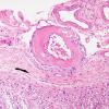 3B1 Arteriolosclerosis (Case 3)  H&E 2