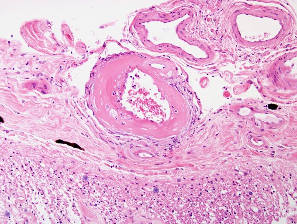 3B1 Arteriolosclerosis (Case 3)  H&E 2