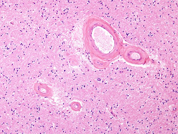 3B2 Arteriolosclerosis (Case 3)  H&E 4