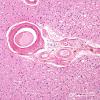 3B3 Hypertension, arteriolosclerosis (Case 3) H&E 1