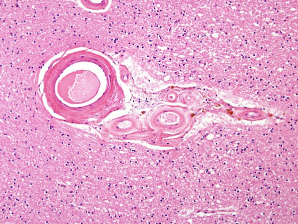 3B3 Hypertension, arteriolosclerosis (Case 3) H&E 1