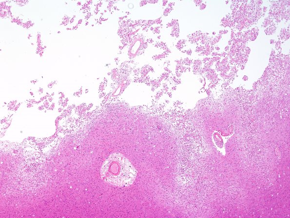 4A3 Hemorrhage, infarcts, arteriolosclerosis, hypertension (Case 4) H&E N15 2