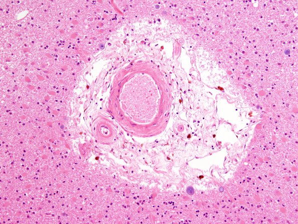 4A4 Hemorrhage, infarcts, arteriolosclerosis, hypertension (Case 4) H&E N15 1