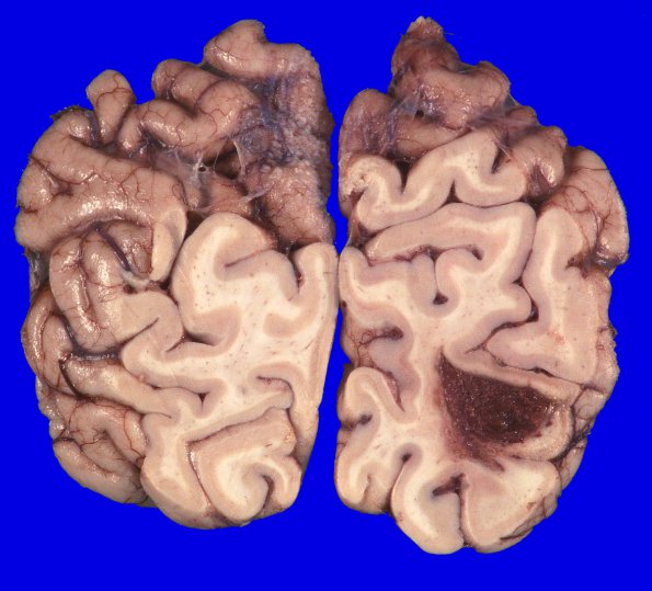 4B1 Hemorrhage, subacute (Case 4) Gross_4