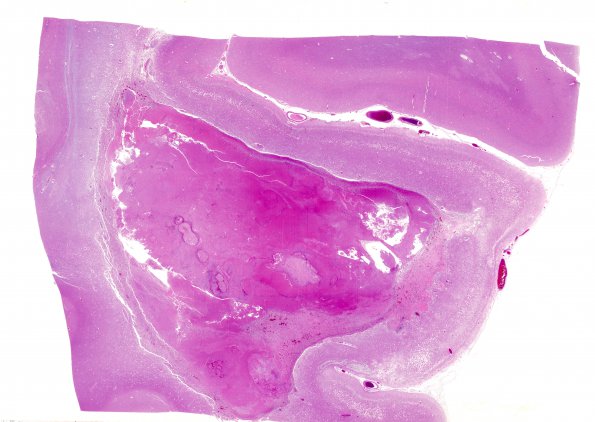 4B2 Hemorrhage, infarcts, arteriolosclerosis, hypertension (Case 4) H&E whole mount N19