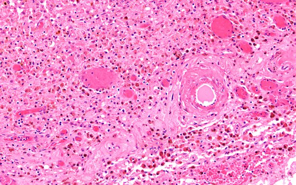 4B3 Hemorrhage, infarcts, arteriolosclerosis, hypertension (Case 4) H&E N16 2