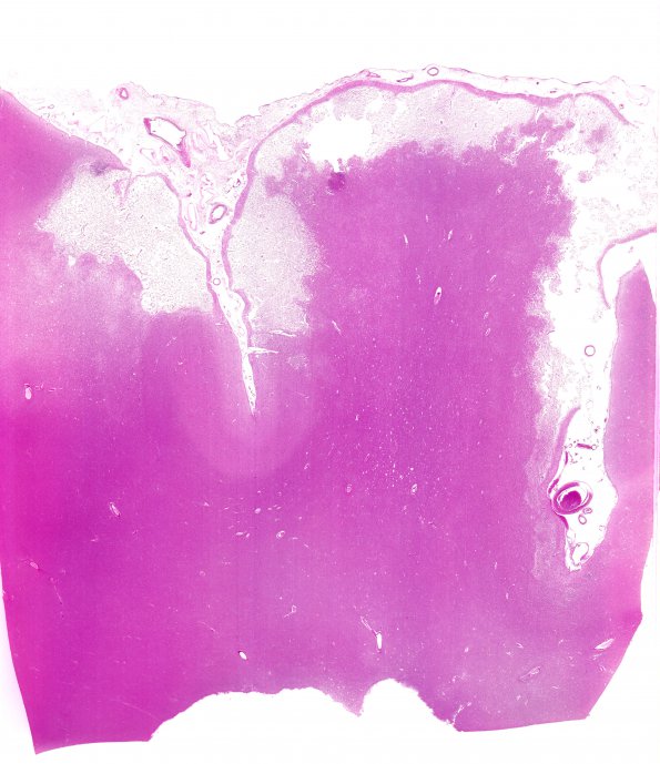 5A1 Infarcts, Atherosclerosis, arteriolosclerosis (Case 5) N5 H&E whole mount