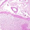 5A2 Infarcts, Atherosclerosis, arteriolosclerosis (Case 5) N11 H&E 1