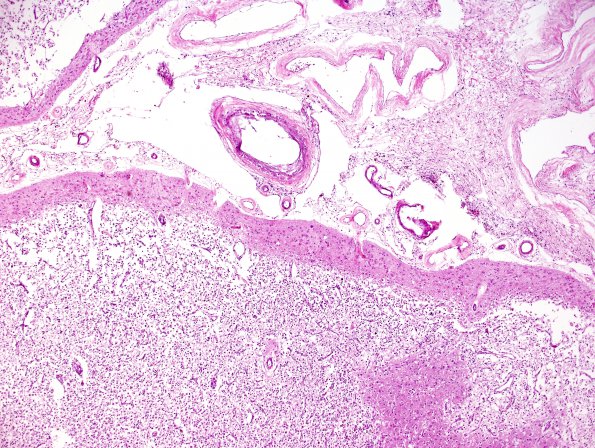 5A2 Infarcts, Atherosclerosis, arteriolosclerosis (Case 5) N11 H&E 1