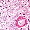 5A3 Infarcts, Atherosclerosis, arteriolosclerosis (Case 5) N14 H&E 5