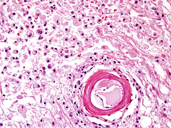 5A3 Infarcts, Atherosclerosis, arteriolosclerosis (Case 5) N14 H&E 5