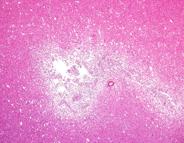 5A4 Infarcts, Atherosclerosis, arteriolosclerosis (Case 5) N14 H&E