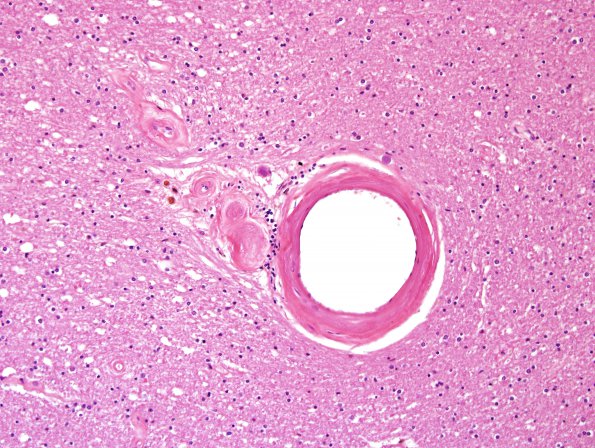 5A5 Infarcts, Atherosclerosis, arteriolosclerosis (Case 5) H&E 1