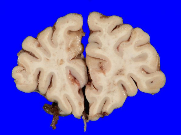 6A1 Infarcts, WM & Lacunar, HT-DM (Case 6) Gross_4