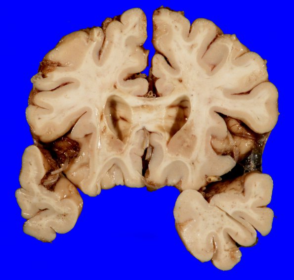 6A2 Infarcts, WM & Lacunar, HT-DM (Case 6) Gross_6