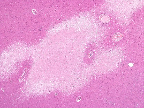 6B2 Infarcts, small vessels, HT 45 yo (Case 6) H&E 4