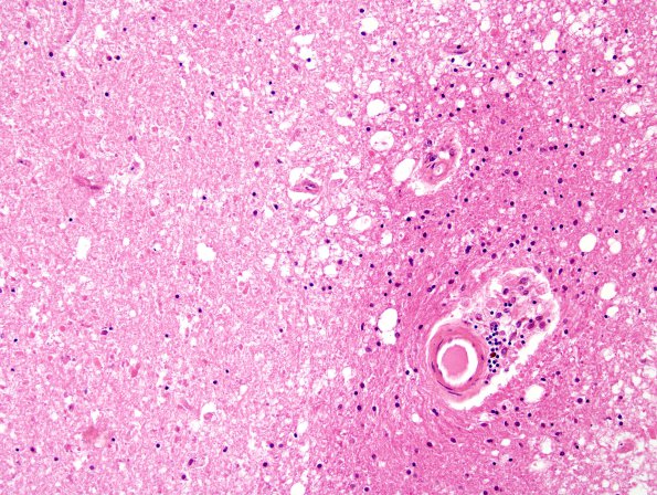 6B3 Infarcts, small vessels, HT 45 yo (Case 6) H&E 2