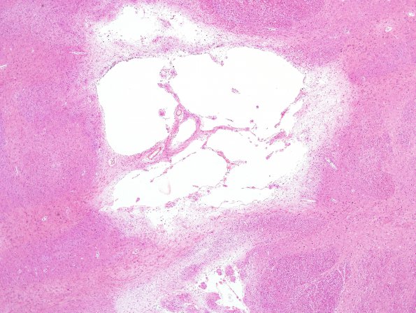 6D2 Infarcts, small vessels, HT in 45 yo (Case 6) Pons H&E 4