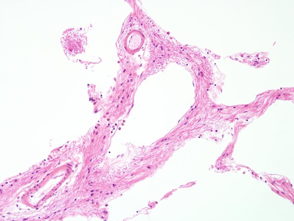 6D3 Infarcts, small vessels, HT in 45 yo (Case 6) Pons H&E 3