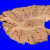 7A1 Arteriolosclerosis (Case 7) Cerebellum _2 copy