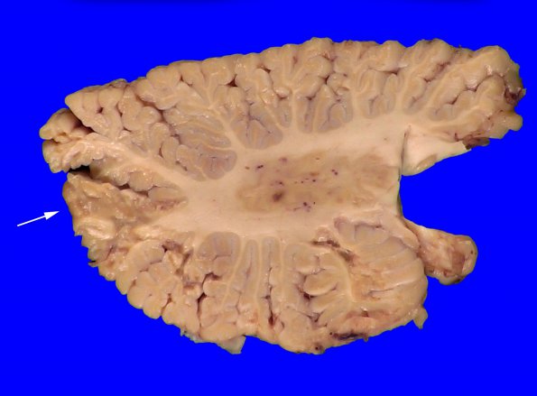 7A1 Arteriolosclerosis (Case 7) Cerebellum _2 copy