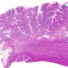 7B1 Arteriolosclerosis (Case 7) N9 H&E WM