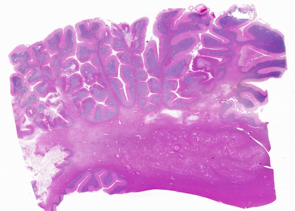 7B1 Arteriolosclerosis (Case 7) N9 H&E WM