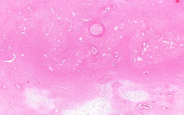 7B2 Arteriolosclerosis (Case 7) N9 H&E 2X