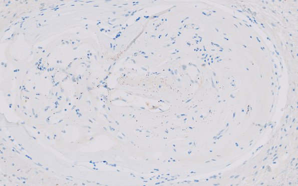 7B4 Arteriolosclerosis (Case 7) N9 BAP 20X