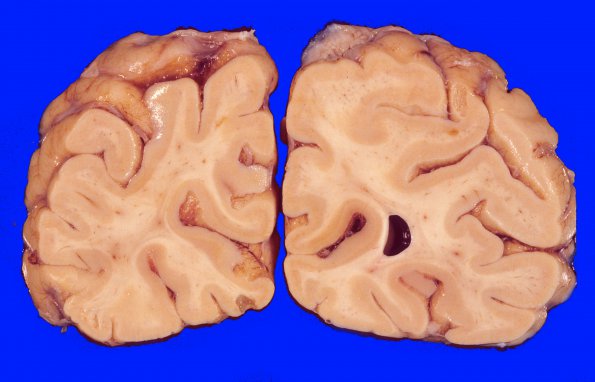 8A1  Arteriolosclerosis, Infarct, Old, pyramid & olive (Case 8) Occipital