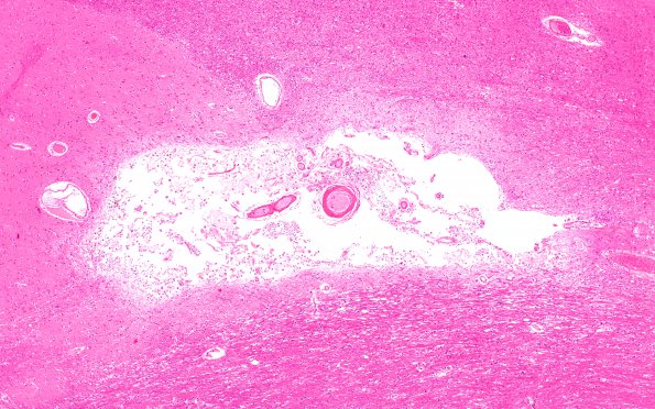 8A2  Arteriolosclerosis, Infarct, Old, pyramid & olive (Case 8) N2A H&E 2X