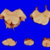 8A3  Arteriolosclerosis, Infarct, Old, pyramid & olive (Case 8) H&E whole mount A1 Medulla