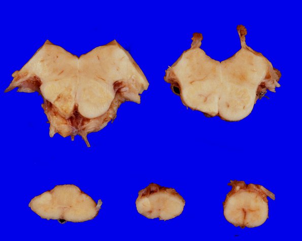 8A3  Arteriolosclerosis, Infarct, Old, pyramid & olive (Case 8) H&E whole mount A1 Medulla