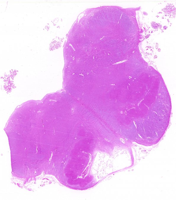 8A4 Arteriolosclerosis, Infarct, Old, pyramid & olive (Case 8) H&E whole mount A3