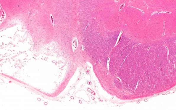 8A5  Arteriolosclerosis, Infarct, Old, pyramid & olive (Case 8) H&E 2X