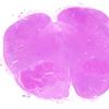 8A6  Arteriolosclerosis, Infarct, Old, pyramid & olive (Case 8) H&E whole mount A1