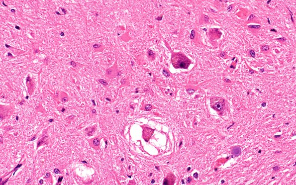 8A7  Arteriolosclerosis, Infarct, Old, pyramid & olive (Case 8) N8A H&E 40X