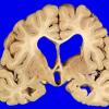 9A1 Infarcts, multiple, HT, dementia (Case 9) _2 copy