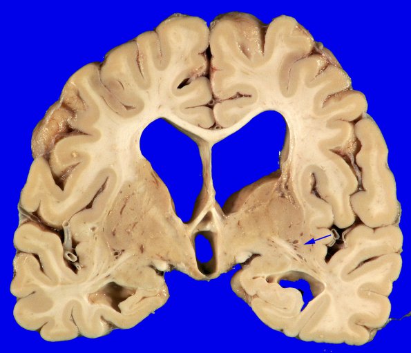 9A1 Infarcts, multiple, HT, dementia (Case 9) _2 copy