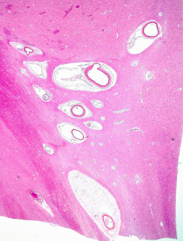 9B1 Infarcts, multiple, HT, dementia (Case 9) N11 H&E 2X.