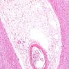 9B2 Infarcts, multiple, HT, dementia (Case 9) N11 H&E 3.