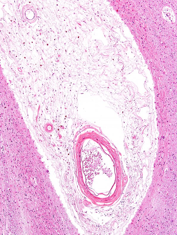 9B2 Infarcts, multiple, HT, dementia (Case 9) N11 H&E 3.