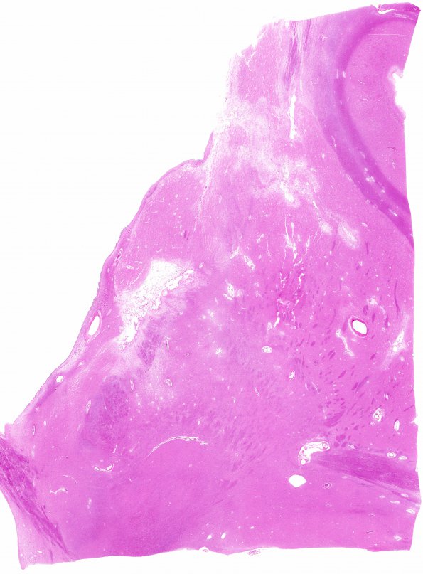 9B3 Infarcts, multiple, HT, dementia (Case 9) N12 H&E whole mount