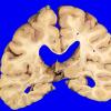 9C1 Infarcts, multiple, HT, dementia (Case 9) _5 copy