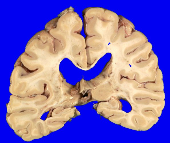 9C1 Infarcts, multiple, HT, dementia (Case 9) _5 copy