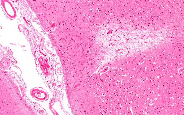 9C2 Infarcts, multiple, HT, dementia (Case 9) N18 H&E 10X 2