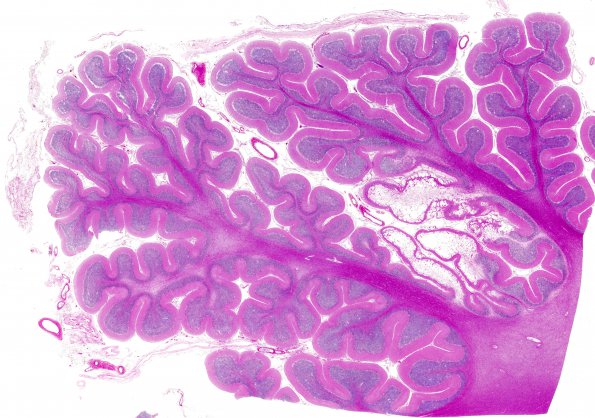 9D1 Infarcts, multiple, HT, dementia (Case 9) N20 H&E whole mount