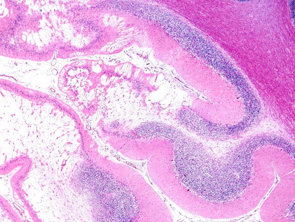 9D2 Infarcts, multiple, HT, dementia (Case 9) N20 H&E 3