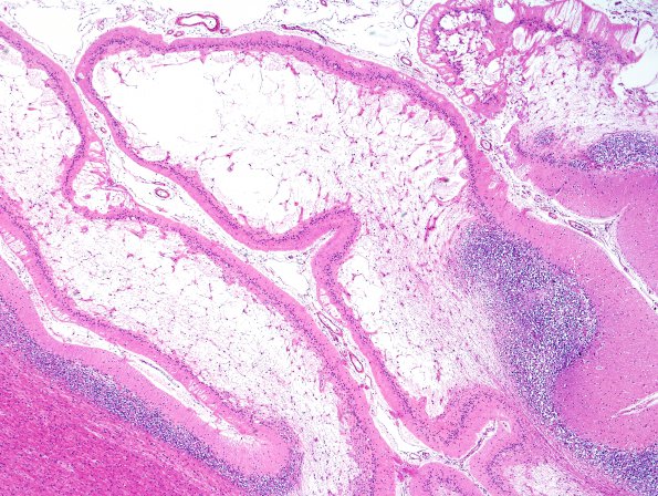 9D3 Infarcts, multiple, HT, dementia (Case 9) N20 H&E 8